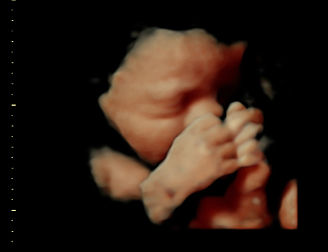 3D ultrasound image at 31 weeks